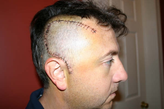 Ronald Strauss following brain surgery.